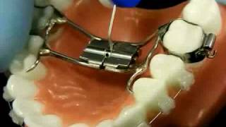 Bracesquestionscom  Orthodontic Jaw Expander How to Turn [upl. by Laniger]