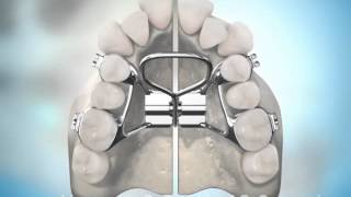 Surgically Assisted Palatal Expansion [upl. by Felicity]