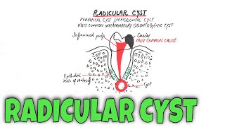 Radicular cyst  Periapical Cyst  Pathogenesis Clinical RF HF amp Treatment [upl. by Barrie]