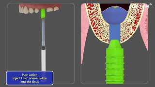 CAS KIT Crestal Approach  Sinus KIT [upl. by Anifares]