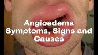 Angioedema  Symptoms Signs and Causes [upl. by Thia]