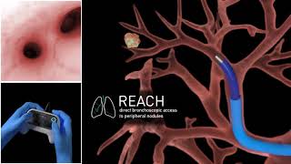 Auris Bronchoscopy Animation [upl. by Enirhtak]