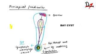 Radicular cyst  PATHOGENESIS CF RF amp TREATMENT [upl. by Avra]