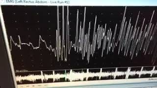 neuromyotonic discharges [upl. by Lotsyrk]