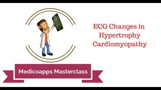 ECG Changes in Hypertrophic Cardiomyopathy [upl. by Dorrej]