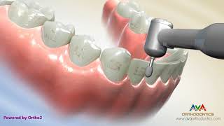 Removing Orthodontic Braces or Debond [upl. by Monney]