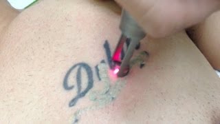 Tattoo Removal using Spectra Laser  Los Angeles Skin Perfect Brothers [upl. by Dionis]