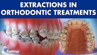 Extractions in Orthodontic Treatment  Is it necessary © [upl. by Aural]