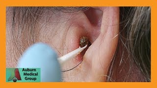 Chunky Earwax Removal  Auburn Medical Group [upl. by Kramal]