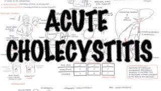 Acute Cholecystitis  Overview signs and symptoms pathophysiology treatment [upl. by Noryv]