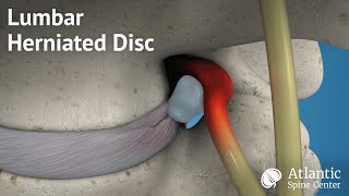 Lumbar Herniated Disc Overview [upl. by O'Hara]