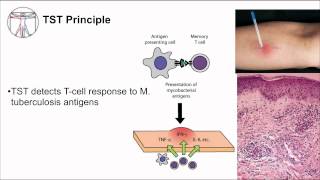 Tuberculosis Diagnosis [upl. by Hserus]