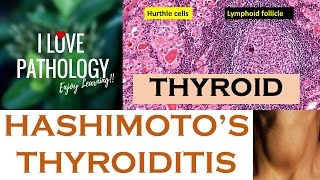 HASHIMOTOS THYROIDITIS Etiopathogenesis Morphology amp Complications [upl. by Salokkin]