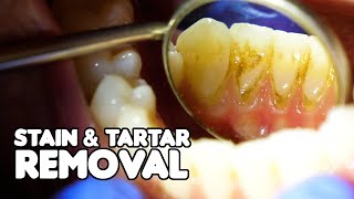 Dental Cleaning EXPLAINED  Stain amp Tartar Removal [upl. by Ziza353]