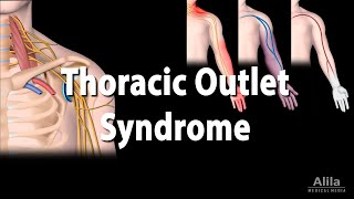 Thoracic Outlet Syndrome TOS Animation [upl. by Mordy33]