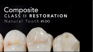 Class II Composite Restoration  5 DO Natural Tooth [upl. by Tiana]