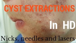 Cysts extractions blackheads  Removal methods in HD [upl. by Fuhrman]