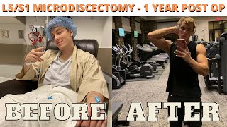 L5S1 Microdiscectomy 1 year post op [upl. by Nigle423]