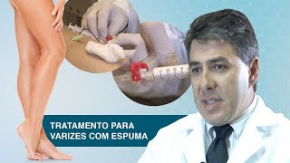 Tratamento para varizes com Espuma [upl. by Annoj830]