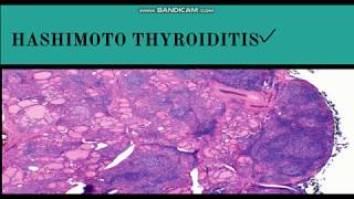 Best Nutrients For Hashimotos Thyroiditis – Dr Berg [upl. by Samalla669]