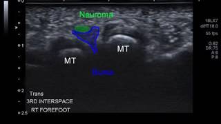 mortons neuroma bursal complex [upl. by Aihsei]