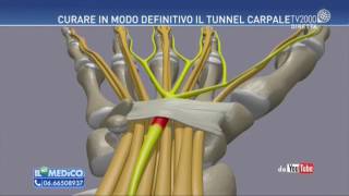 Il mio medico  Tunnel Carpale come curarlo [upl. by Oirifrop705]