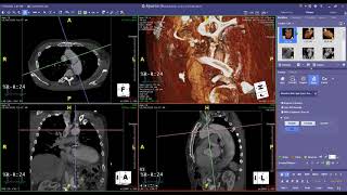 Thoracic Endovascular Aortic Repair TEVAR [upl. by Yornek]