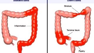 Crohn Disease [upl. by Oiluig437]