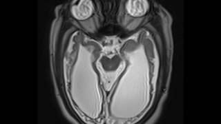 Periventricular Leukomalacia [upl. by Ahtiekahs654]