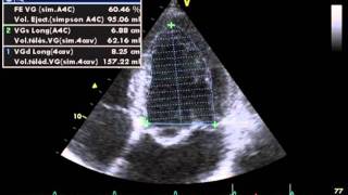 ACCURATE MEASUREMENT OF LVEF left ventricular ejection fraction by biplane simpsons method [upl. by Anilatac861]