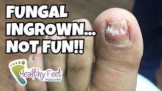 Removing a Fungal Ingrown Nail [upl. by Yraunaj]