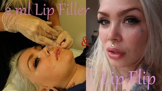 2ml Lip Filler And Lip Flip [upl. by Onitsoga42]