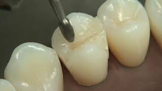 Class II Composite Preparation amp Restoration  Operative Dentistry [upl. by Lorrimor]