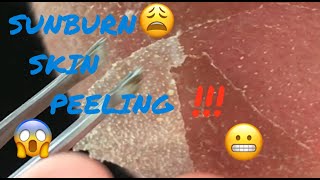 Satisfying Sunburn Skin Peeling 😬😦 [upl. by Yroggerg]