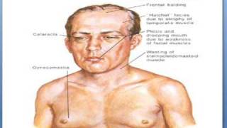 Myotonic dystrophy [upl. by Thistle]