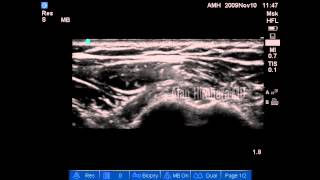 Ultrasound guided injection  Biceps tendon PRP [upl. by Darbie89]