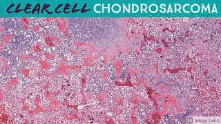 Clear Cell Chondrosarcoma [upl. by Yhtomit946]