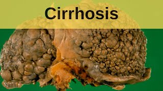 Cirrhosis  Pathology mini tutorial [upl. by Jae]