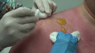 Popping Big Sun Burn Blisters with Dr G [upl. by Elleiad]