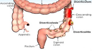 Diverticulitis [upl. by Espy874]