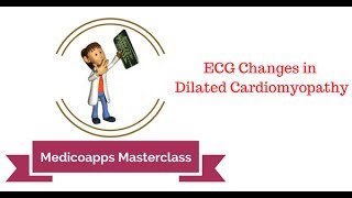 ECG Changes in Dialated Cardiomyopathy [upl. by Tsepmet578]