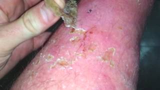 peeling scab  Sunburn [upl. by Ragg]