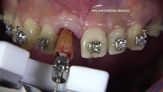 New Way to Extract Teeth [upl. by Annavas354]