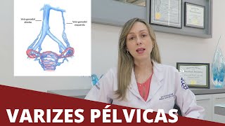 Varizes pélvicas  Dra Nayara Cioffi Batagini  Cirurgia Vascular e Endovascular [upl. by Grand]