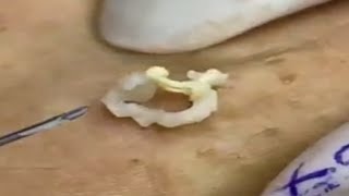 Cyst and blackheads extraction 267  Loan Nguyen [upl. by Noevad]