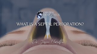 What is a septal perforation [upl. by Shae]