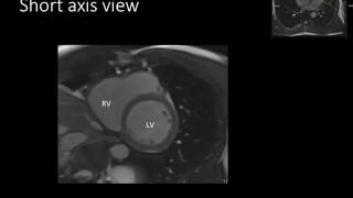 TMT Cardiac MR by Dr Avanti Gulhane Anatomy Basics [upl. by Jenne]