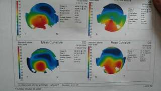 Corneal topography explained [upl. by Coppola]