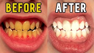 How I Whitened My Teeth in 14 Days [upl. by Nowd]