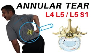 Annular Tear L4L5 L5S1 Disc Bulges [upl. by Anilat748]